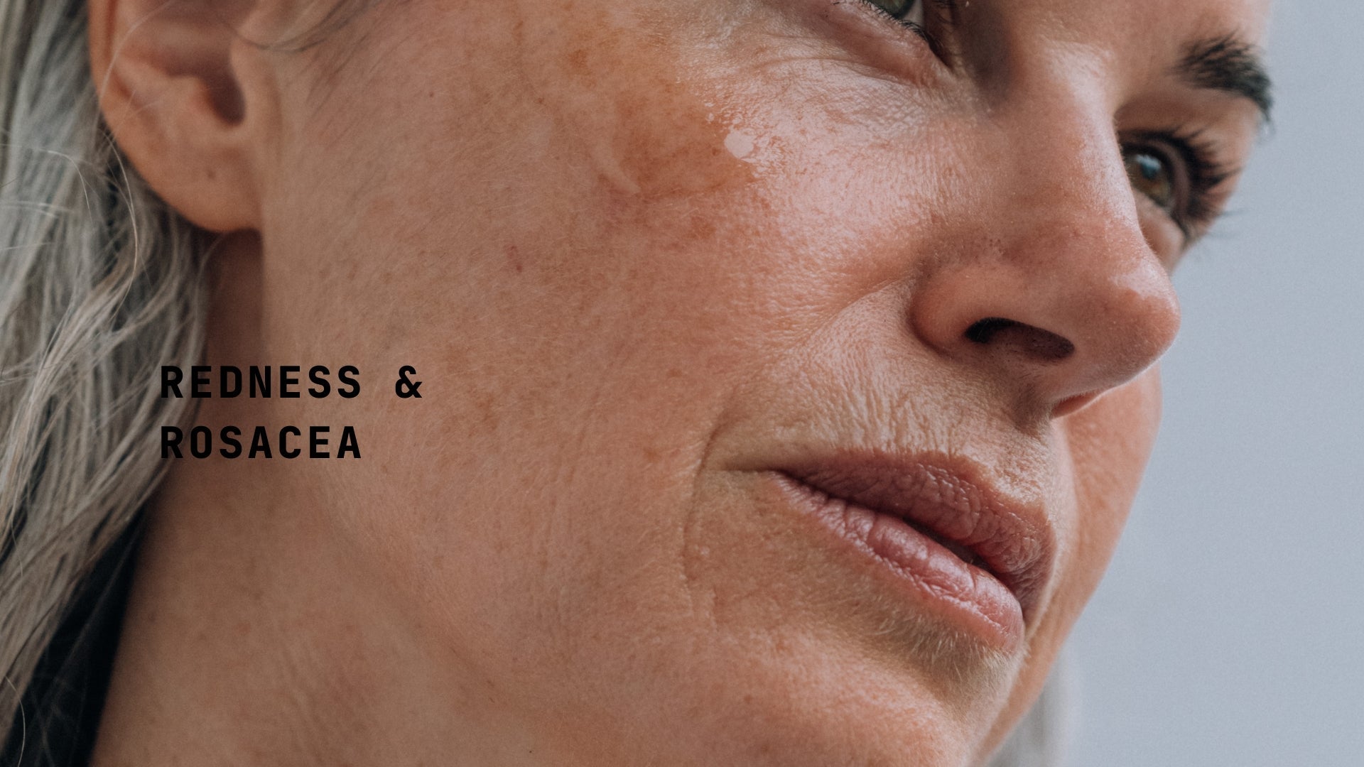 Redness & Rocesea - TYPEYOURSKIN