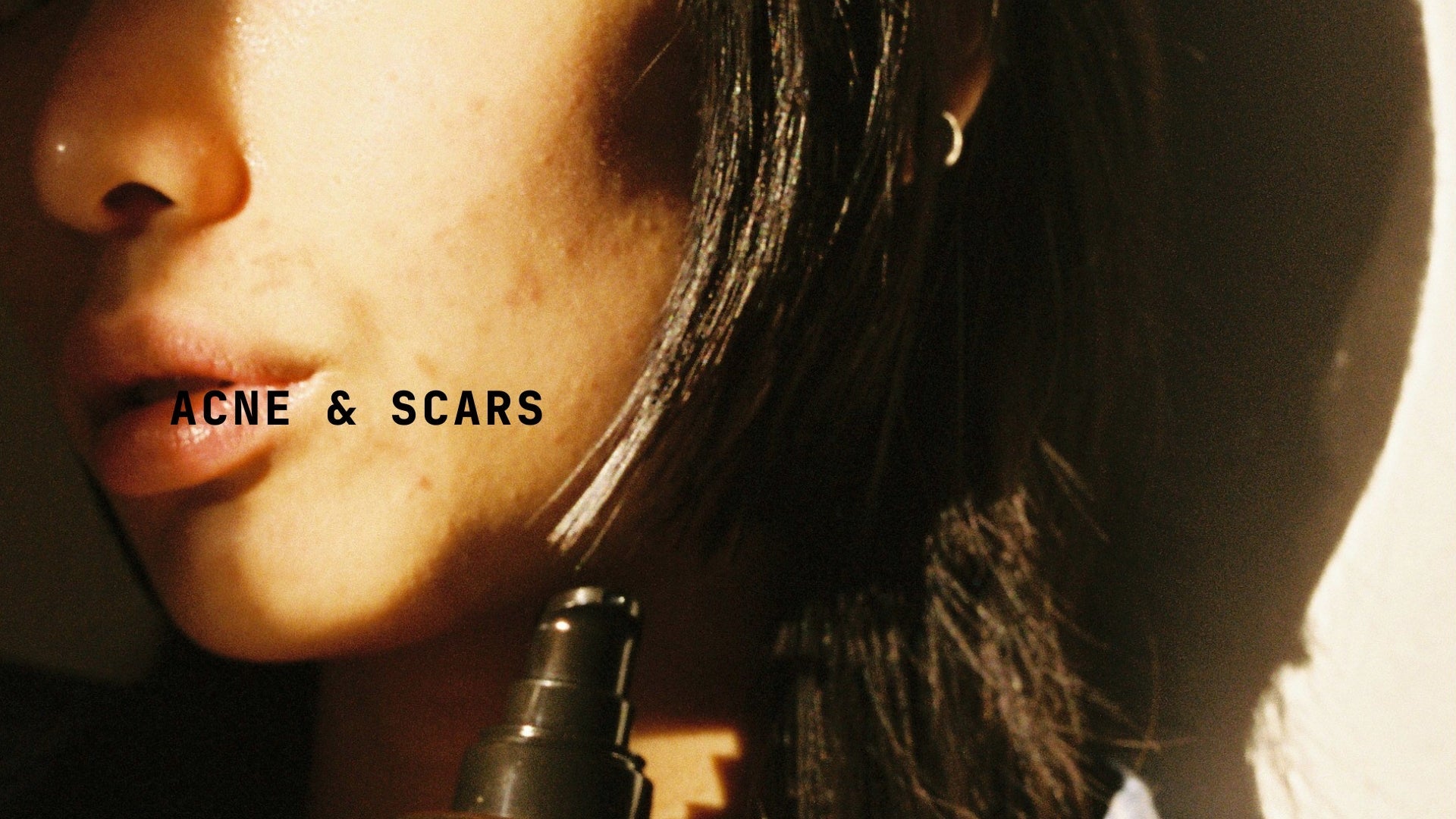 Acne & Scars - TYPEYOURSKIN
