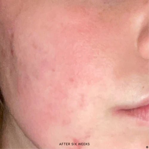 2% BHA Exfoliating Toner - TYPEYOURSKIN - WOODS COPENHAGEN - TYPEYOURSKIN