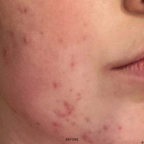 2% BHA Exfoliating Toner - TYPEYOURSKIN - WOODS COPENHAGEN - TYPEYOURSKIN